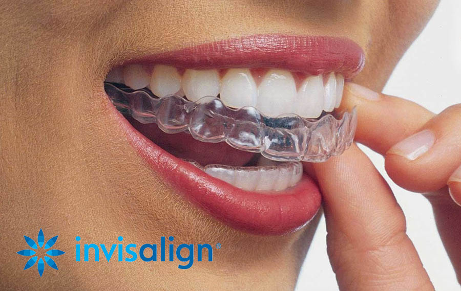 invisalign