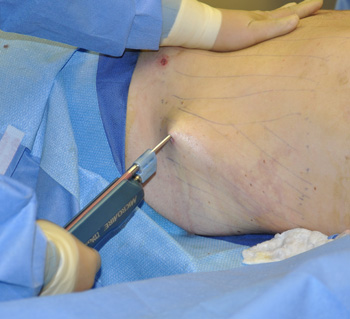 Power Assisted Liposuction.