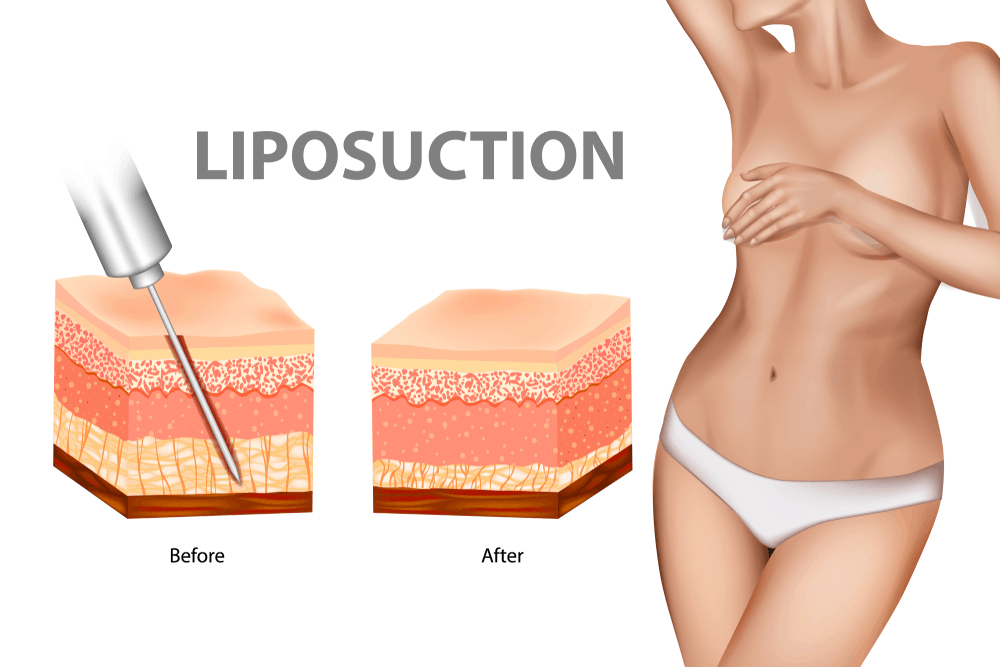 Tumescent-Liposuction