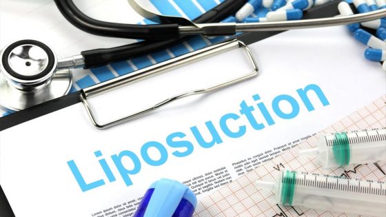 what is liposuction