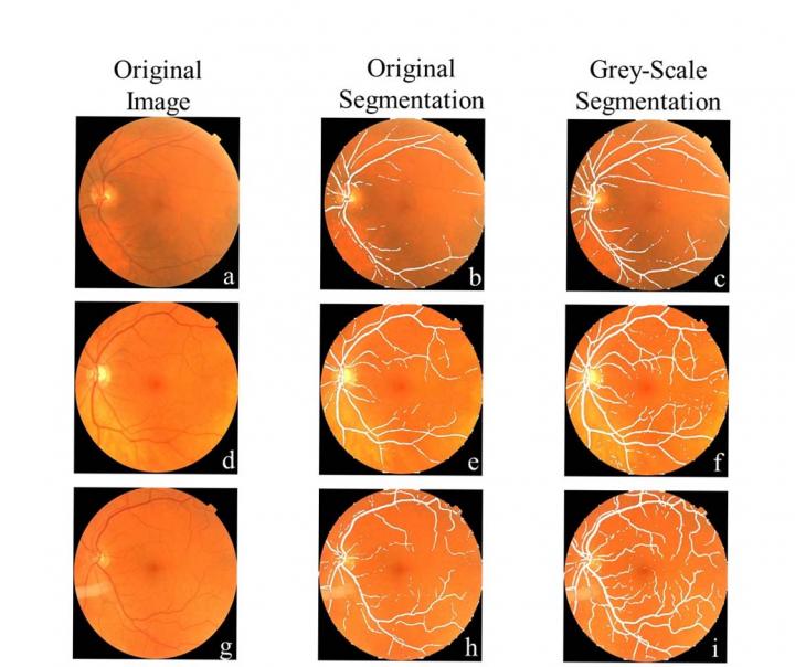 Comparison of vessel segmentation eye