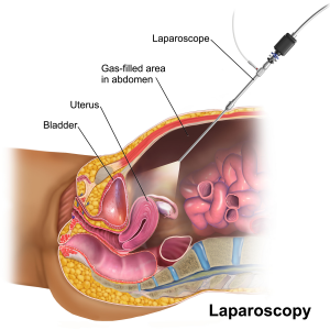 Laparoscopy of hernia