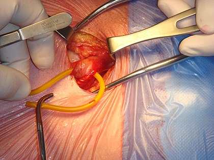 surgery hernia