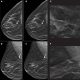 digital breast tomosynthesis