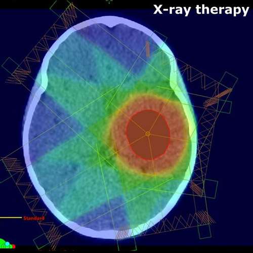 xray-therapy